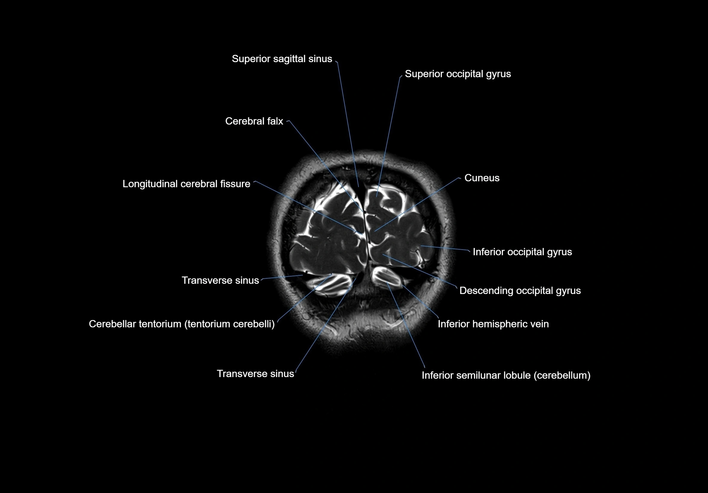 MRI Brain coronal cross sectional labelled anatomy 3T image  -img-00001-00069.webp